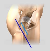minimally hip replacement