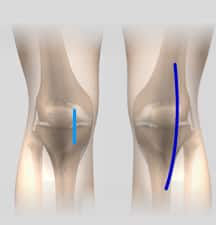 minimally knee replacement